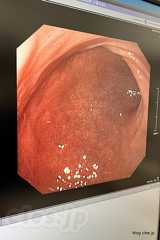 胃カメラ画像 - ピロリ菌除菌後の胃カメラは異状なし