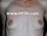 breasts before being pregnant