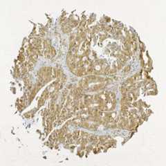 Click to enlarge image Tissue Micro-Array(TMA) core of colon cancer showing cytoplasmic staining using Antibody CPTC-OTUB1-2. Titer: 1:30000