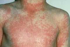 A red, patchy rash on the chest, neck and upper arms caused by scarlet fever. The rash is shown on white skin.