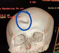 A dent (circled) is seen in a CT scan image