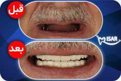 ایمپلنت دندان