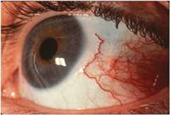 عفونت انگلی «آکانتامبا»؛ خطر تشخیص اشتباه و از دست رفتن دائم بینایی