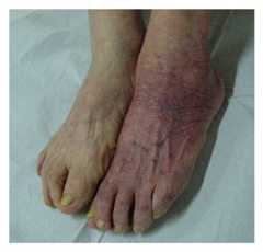 Acrodermatitis chronica atrophicans