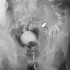 Barium enema findings
