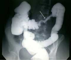 Barium enema showing apple core appearance