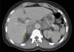 Bilateral adrenal hemorrhages