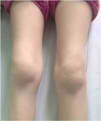 Bilateral knee arthritis