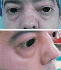 Bilateral proptosis granulomatosis Bilateral proptosis - granulomatosis