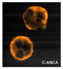 C anca C-anca granulomatosis