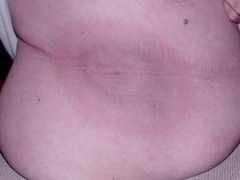 Classic bull's eye EM Lyme disease
