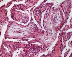 Cryptogenic organizing pneumonia