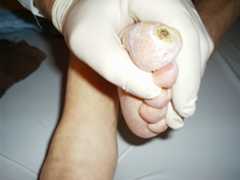 Diabetic foot syndrom