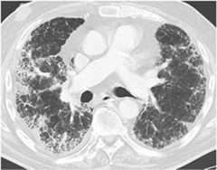 Drug induced lung disease