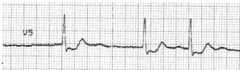 Ecg scooping st segment depressionin