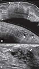 Fibrocystic change