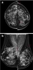 Fibrocystic changes in 50-year-old woman