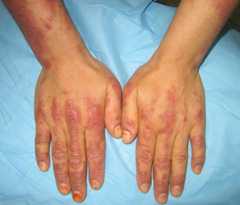 Gottrons papules in dermatomyositis Gottron’s papules in dermatomyositis