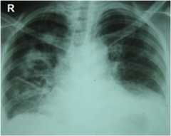 Granulomatosis chest radiography Granulomatosis chest radiography