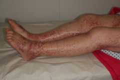 Hallmark purpuric rash of henoch-schönlein purpura