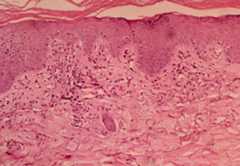 Histologic findings of dermatomyositis three Histological findings of dermatomyositis three