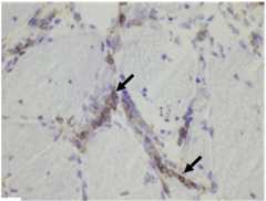Histologic findings of dermatomyositis two Histological findings of dermatomyositis two