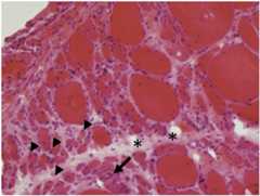 Histologic findings of dermatomyositis Histological findings of dermatomyositis