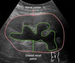 Hydronephrosis on renal ultrasound