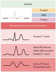 Hyperkalemia ekg