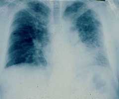 Idiopathic pulmonary fibrosis
