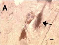 Lewy bodies confirming parkinson's disease