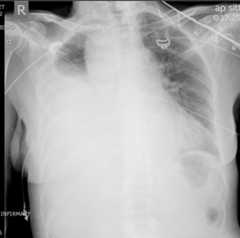 Massive right Massive right hemothorax