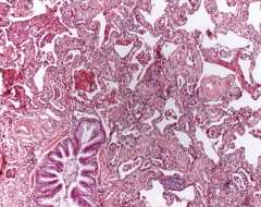 Non specific interstitial pneumonia