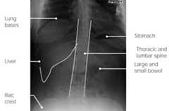 Normal abdominal radiograph
