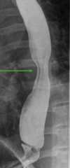 Normal barium swallow shows normal peristalsis (arrow)