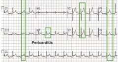 Pericarditis ecg