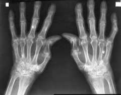 Rheumatoid arthritis X-ray
