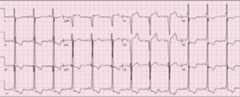 Ste secondary to left ventricular hypertrophy
