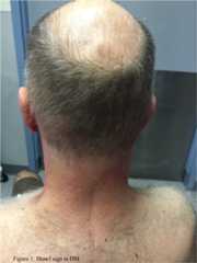 Shawl sign in dermatomyositis Shawl sign in dermatomyositis