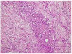 Skin biopsy granulomatosis Skin biopsy - granulomatosis