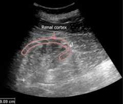 Small kidney with a thin cortex