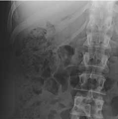 Stool on supine abdominal X-ray