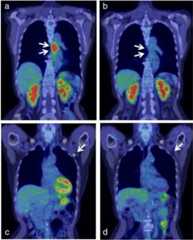 Successfully treated advanced esophageal cancer