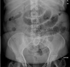 Supine abdominal x-ray