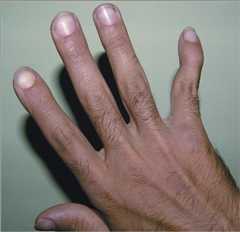 Swan-neck deformity in the fifth finger