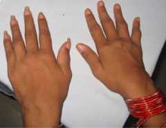 Symmetrical synovitis of wrists