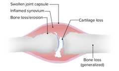 The pathological joint changes in rheumatoid arthritis