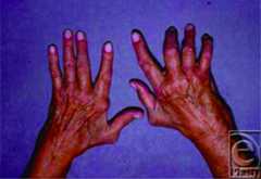 The rheumatoid hand