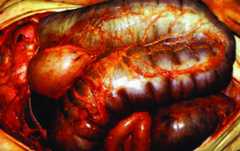 Toxic megacolon in operation