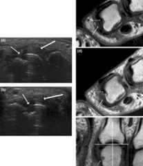 Ultrasounds rheumatoid arthritis